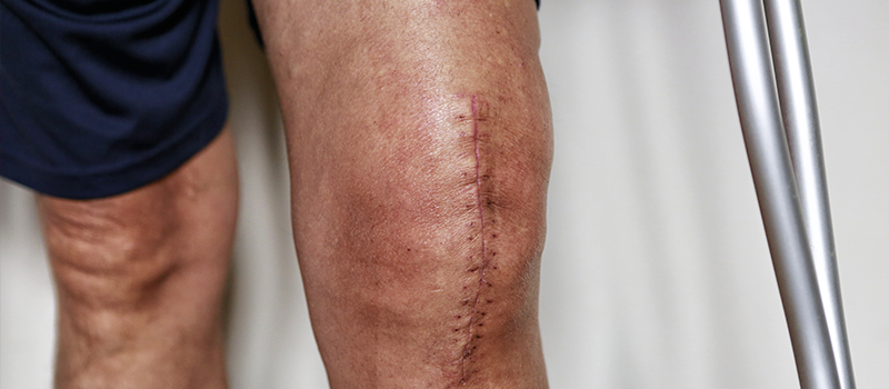 Photo d'une cicatrice au niveau du genoux