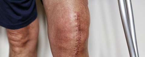 Photo d'une cicatrice au niveau du genoux